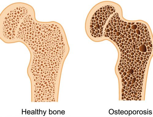 More on Osteoporosis