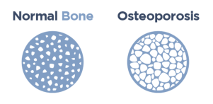 Diagram of osteoporosis condition.