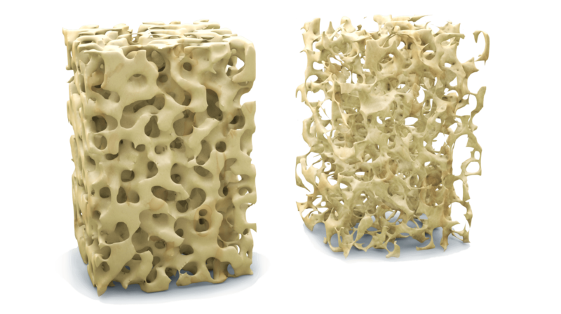 Diagram of osteoporosis effects on bones.